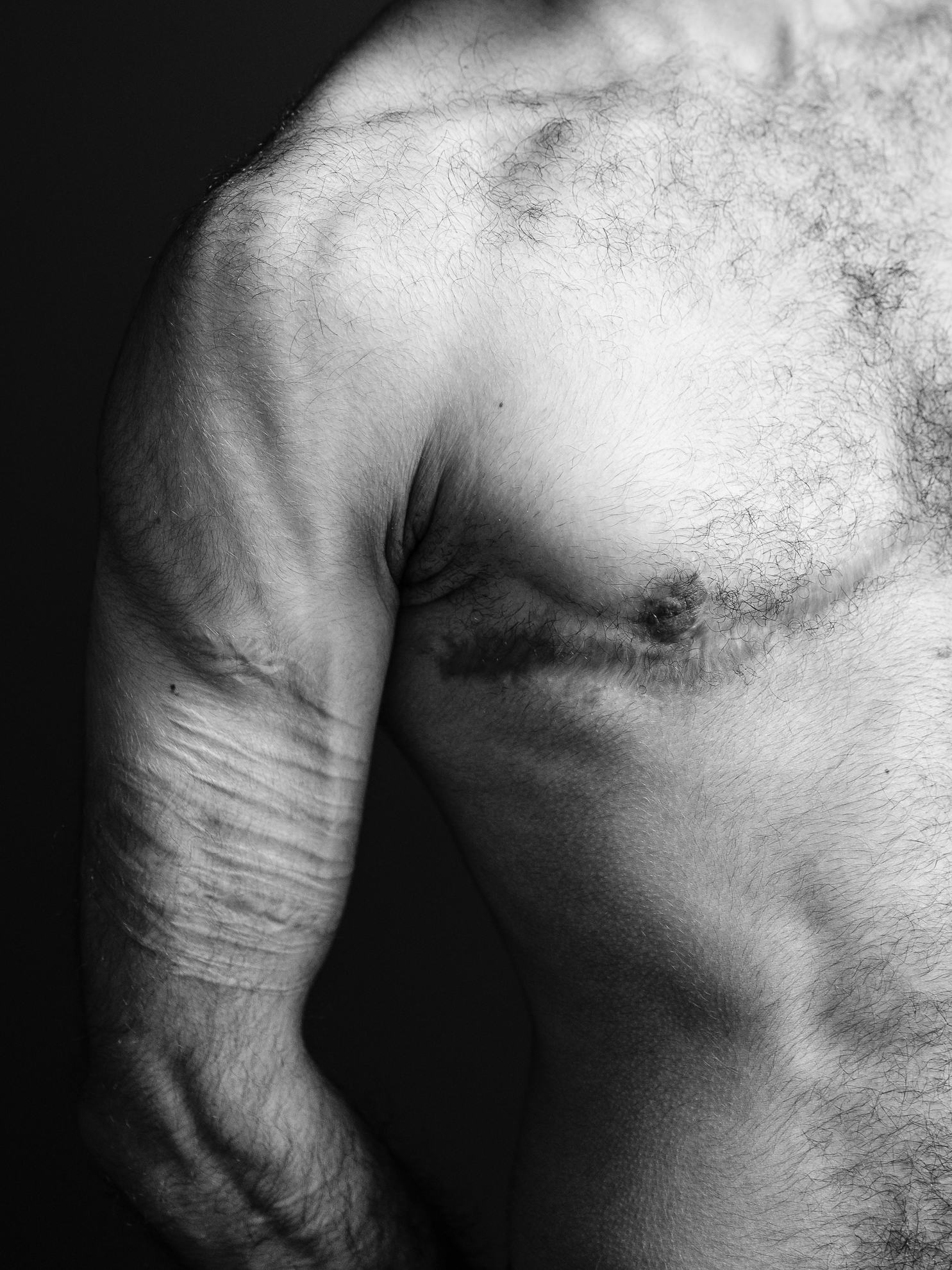 Black and white self portrait, showing scars on upper arm. © Marvel Harris