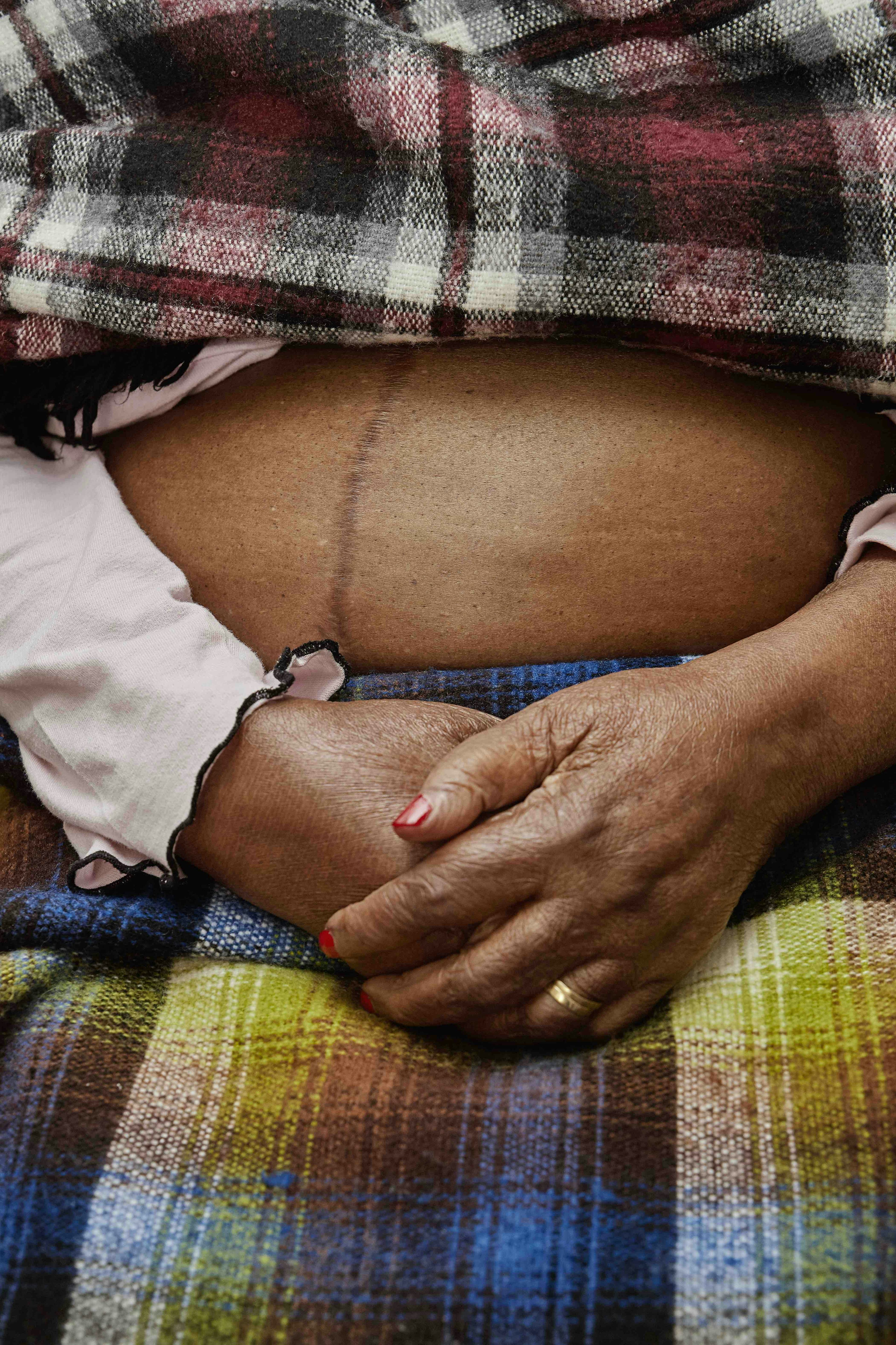 Zoomed in image of a belly, showing a scar, and the hands of a Black woman, with checkered clothing. © Thero Makepe